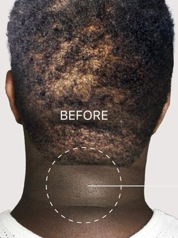 Hair restoration treatment before photo.