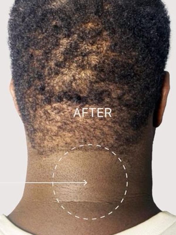 Hair restoration before and after treatment.
