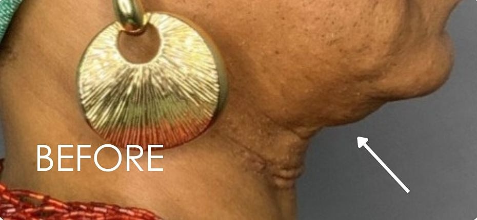Kybella Before & After