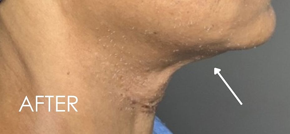 Kybella Before & After