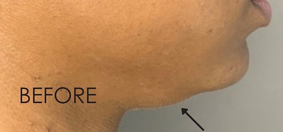 Kybella Before & After