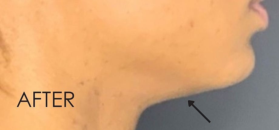Kybella Before & After
