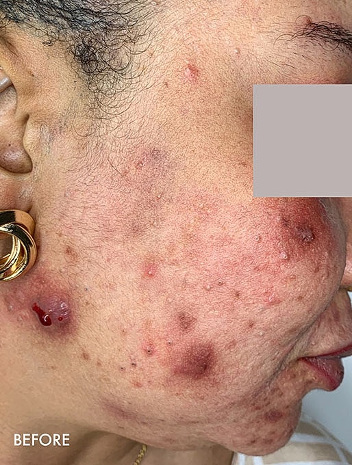 Vi Peels Before & After