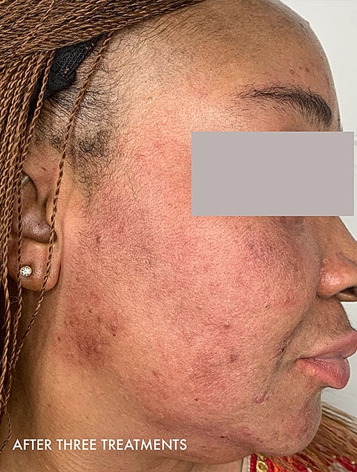 Vi Peels Before & After