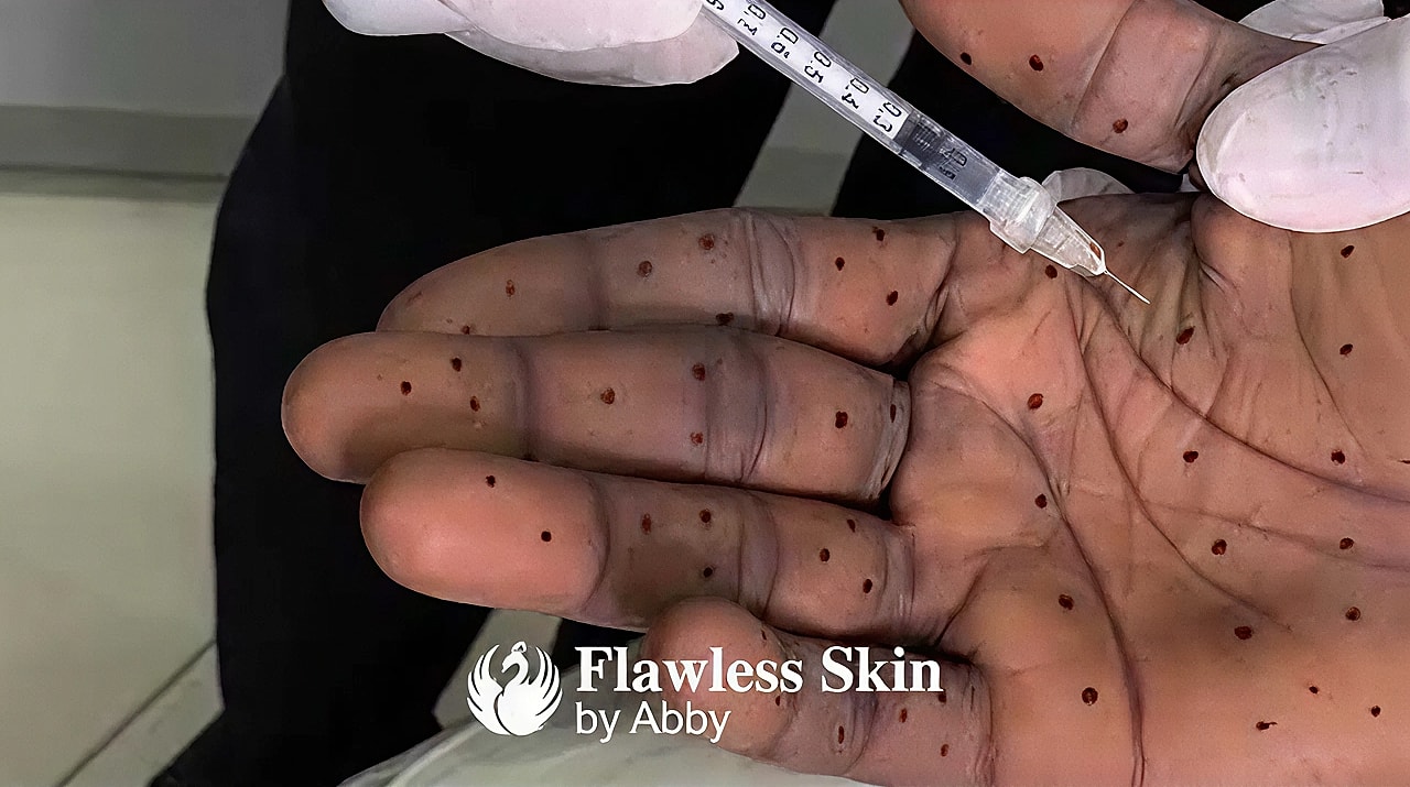 Injection process on hand with marked dots.
