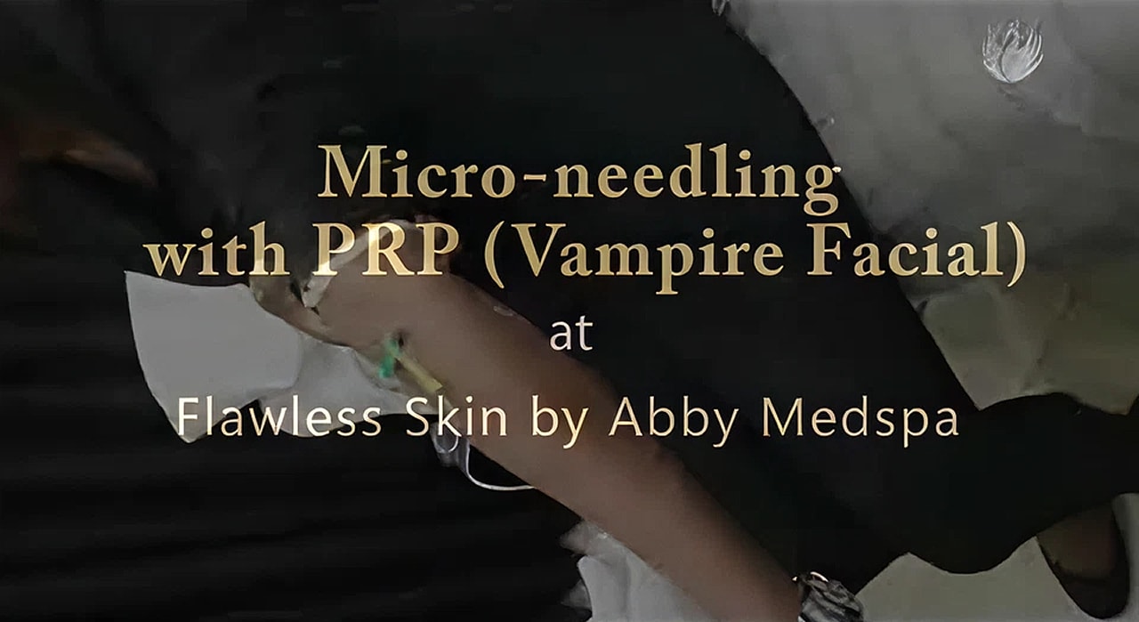 Micro-needling treatment at Abby Medspa.
