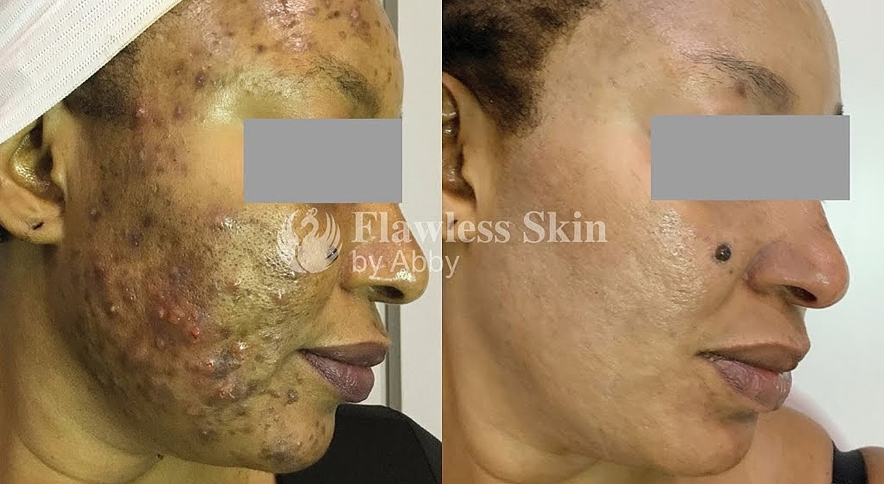 Before and after skin treatment comparison.